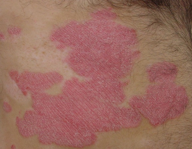 psoriasisplaque
