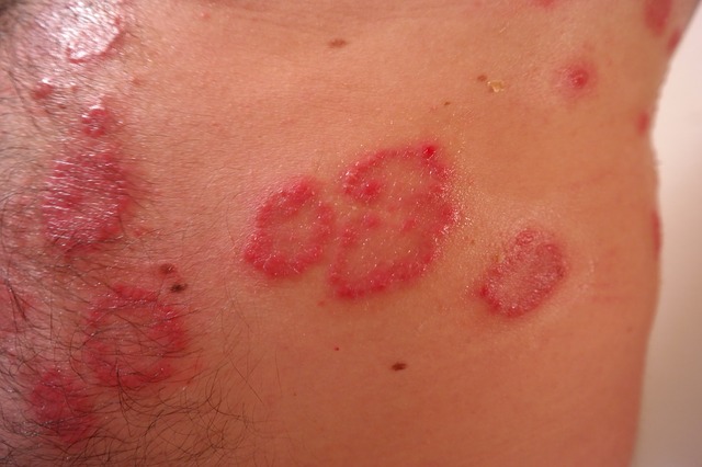 rash-356432_640